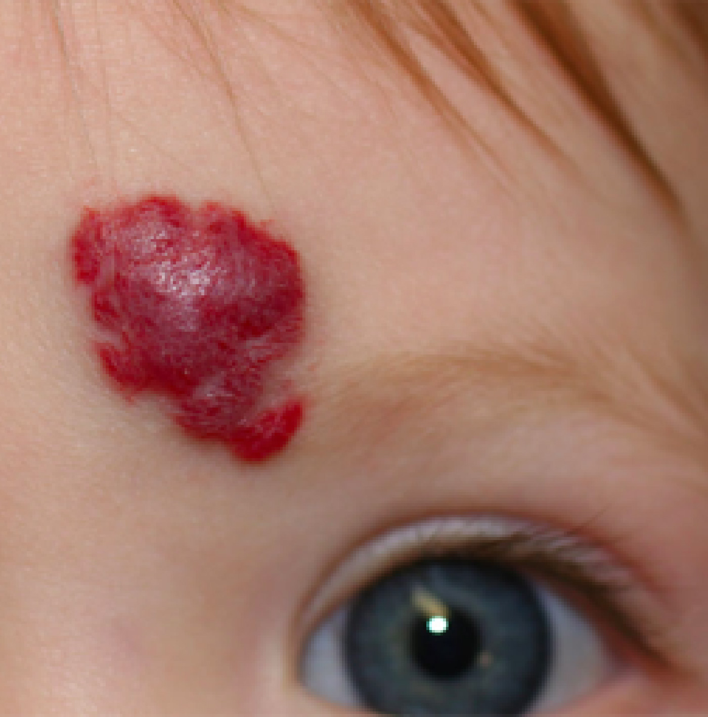 Hemangiomas