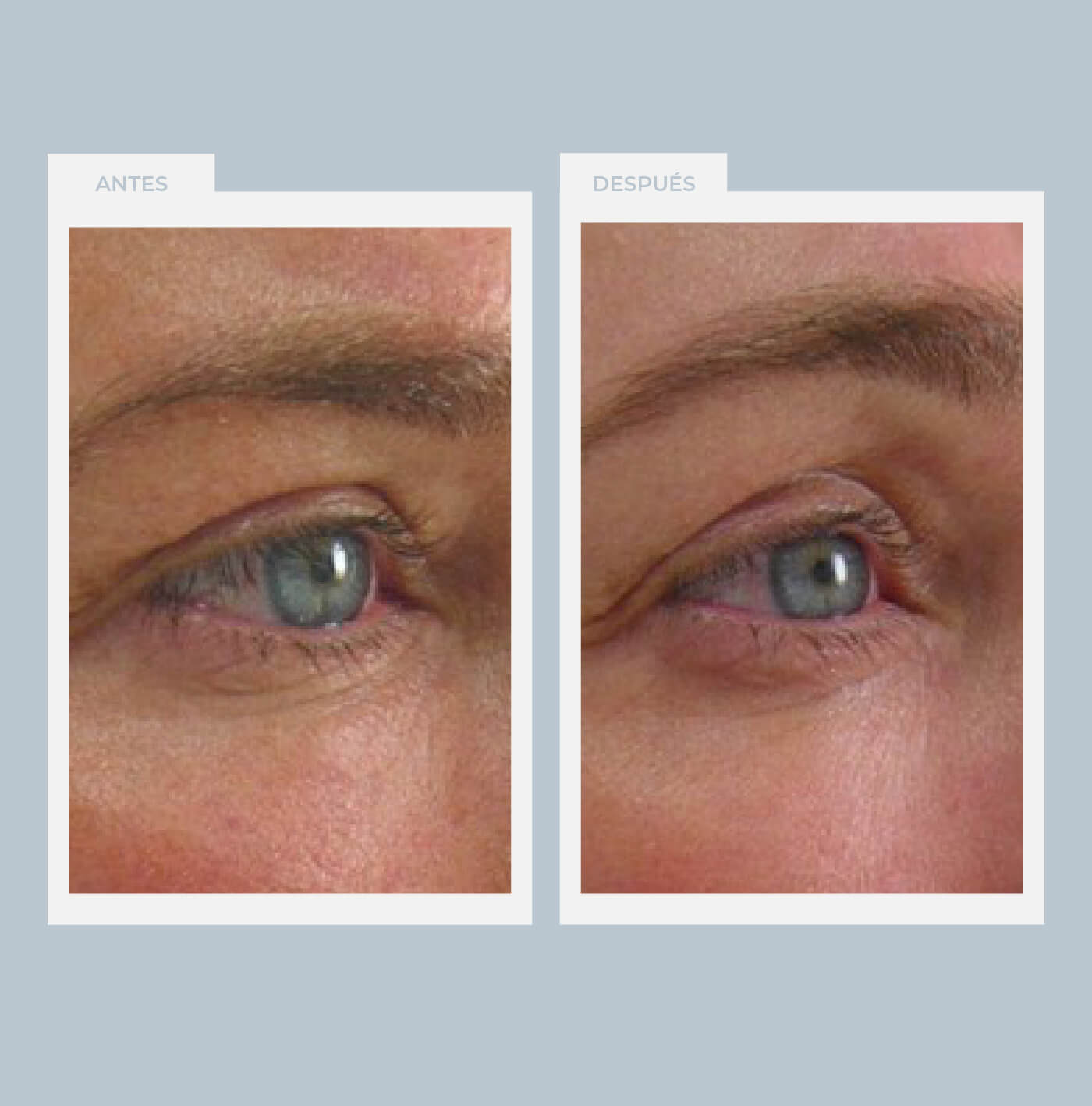 Ultherapy para párpados